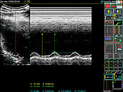 УЗИ сердца. Эхокардиография