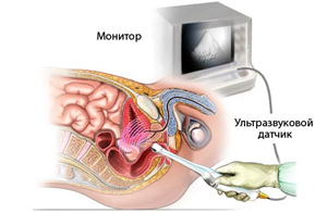 Tрансректальное ультразвуковое исследование