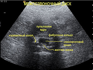 Различные структуры межпозвоночного диска - поясничный отдел