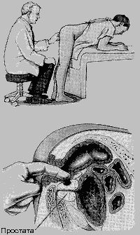 Диагностика простатита