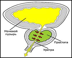 Простатит