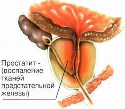Что такое застойный простатит