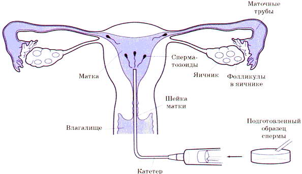 маточная инсеминация