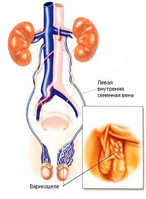 Варикоцеле