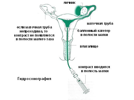 гидроультрасонография